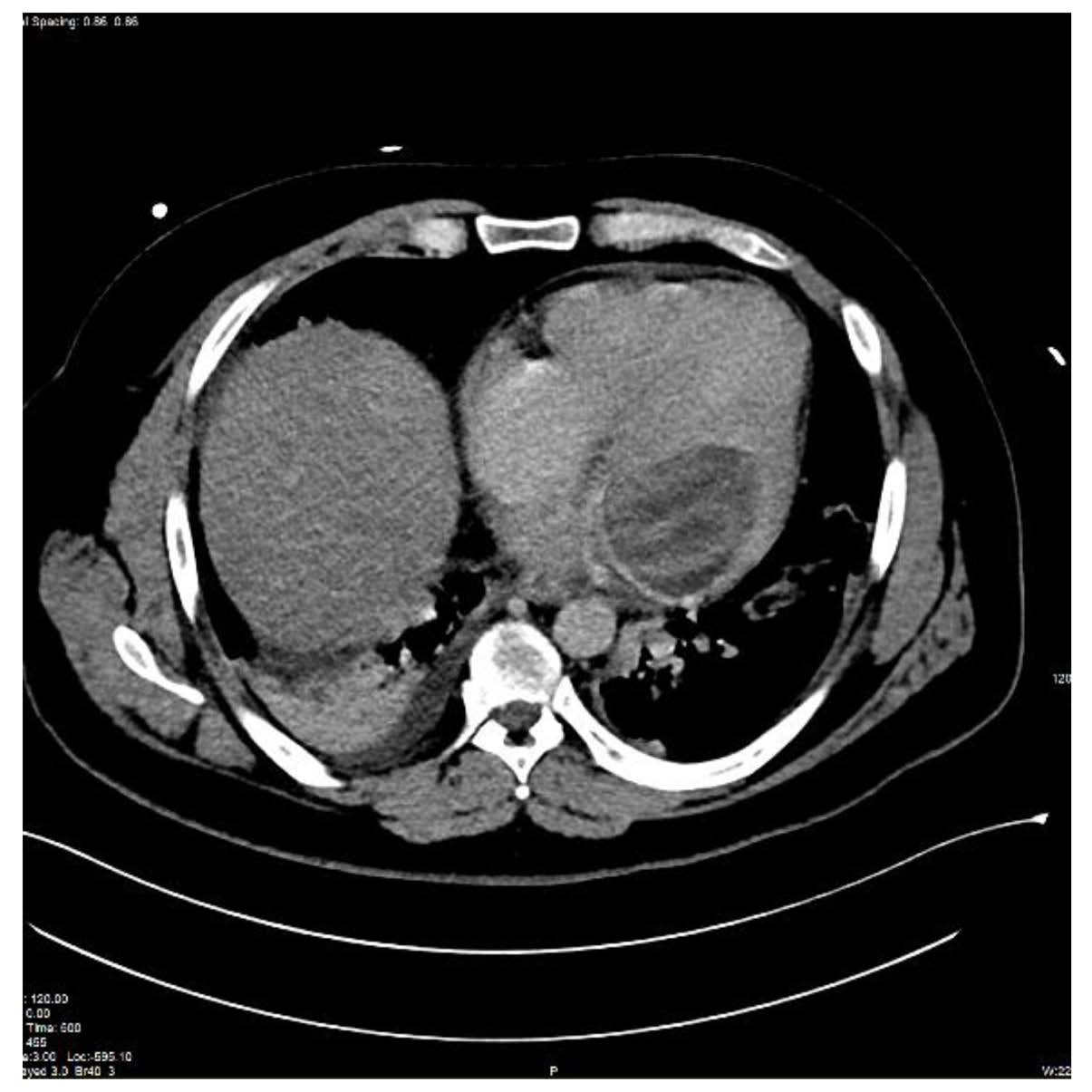 Contrast-enhanced computed tomography imaging of the chest