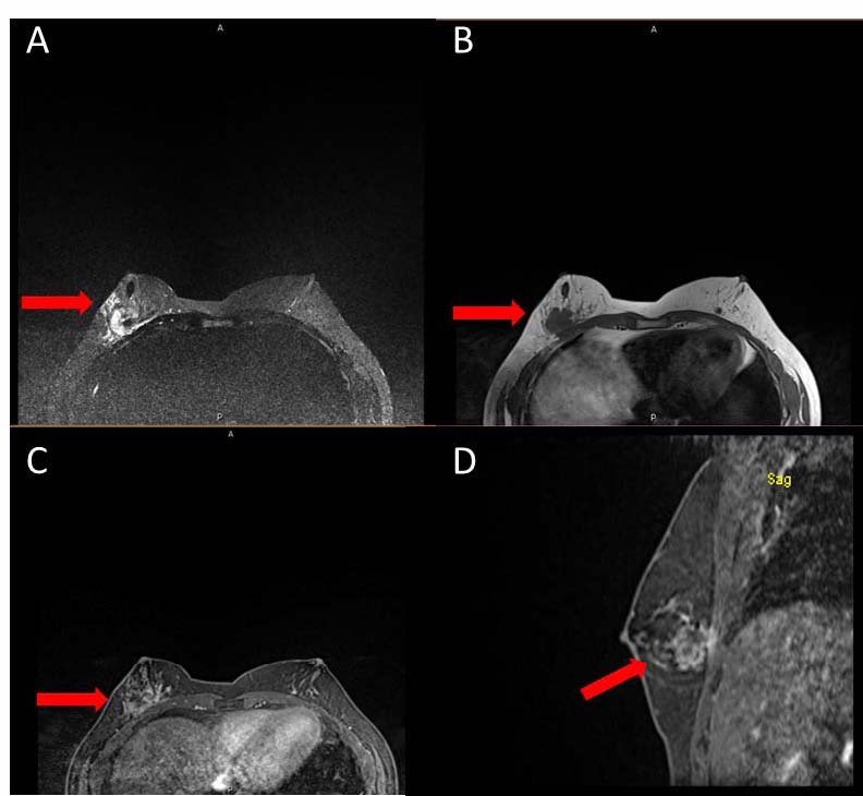 Breast MRI with (a) axial STIR, (b) axial T1, (c) axial T1 Dynamic contrast enhanced, and (d) sagittal.