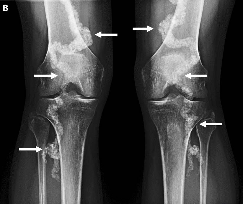 AP radiograph of the bilateral knees demonstrates marked tortuosity and extensive arterial calcification in the bilateral popliteal arteries (arrows).