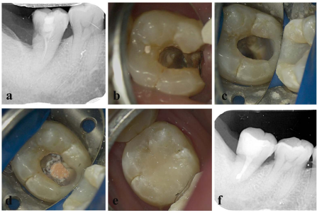 Initial pretreatment radiograph indicating a single root canal in the mandibular second molar. (b) Intraoral photograph showing the  canal orifice. (c) Intraoral photograph demonstrating the use of rubber dam isolation. (d) Root canal filling using thermo-coagulation technique (e)  Complete root canal treatment with resin restoration. (f) Post-obturation radiography.