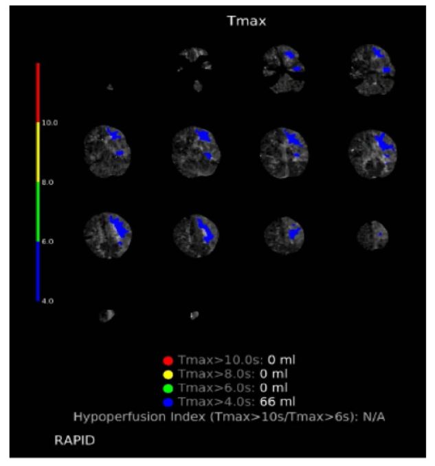 10 year old female CT perfusion study axial cuts showing increased Tmax as compared to the contralateral hemisphere in the left MCA territory