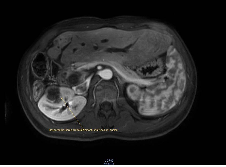 Axial section: Contrast injection displaying peripheral enhancement of the renal mass within a context of peritoneal carcinosis and rectal tumor recurrence, suggesting a secondary right renal mass.