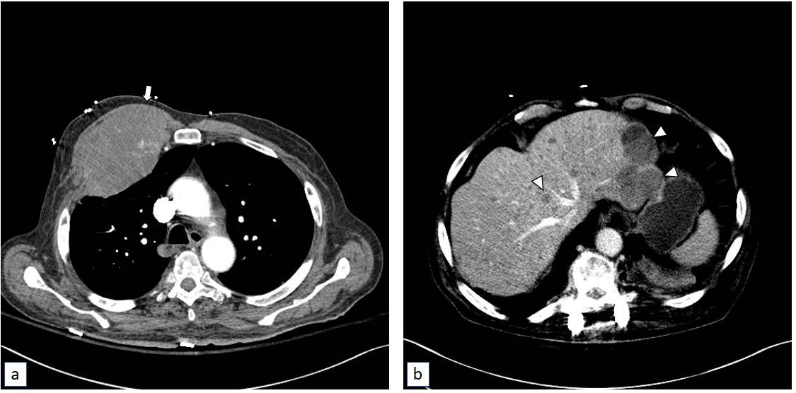 One month later, progression of metastatic disease is noted on imaging for other clinical indications