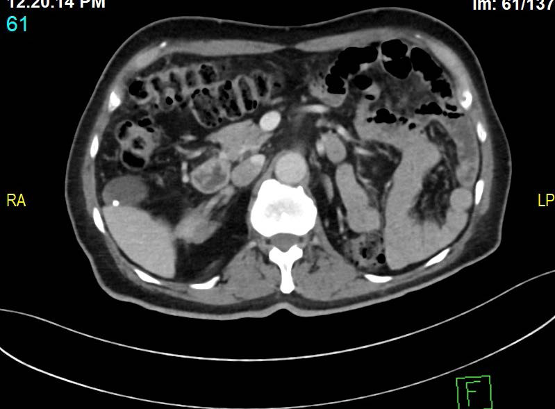 Contrast enhanced CT of the abdomen. Axial view shows the presence of the pancreatic head and uncinate process.