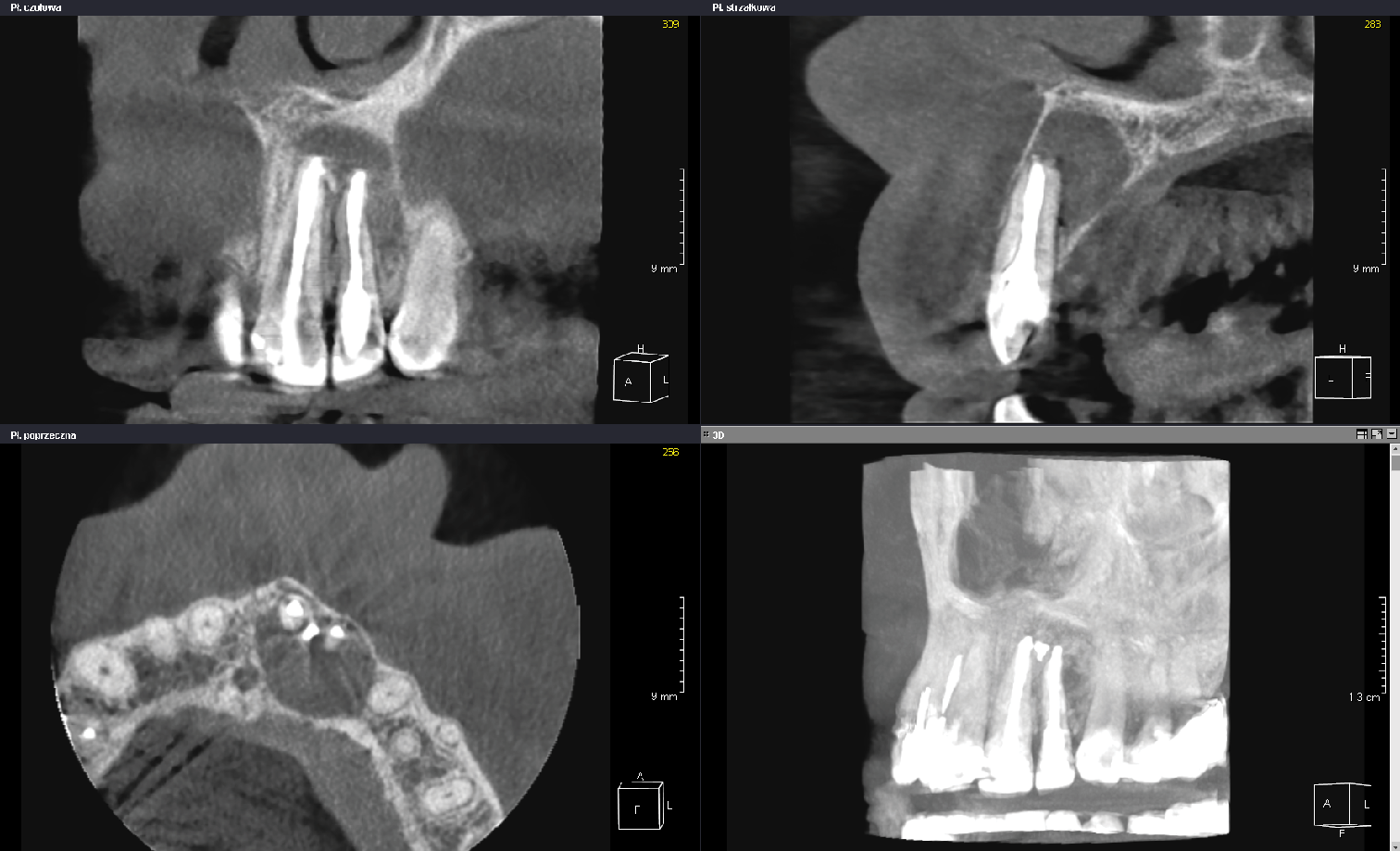 54 year old female with apical periodontitis of teeth 21 and 22; CBCT: FOV 5x5 cm, voxel size 0,125 mm, 353,2 mGycm2, 6,3 mA, 90 kV, 6,1 s
