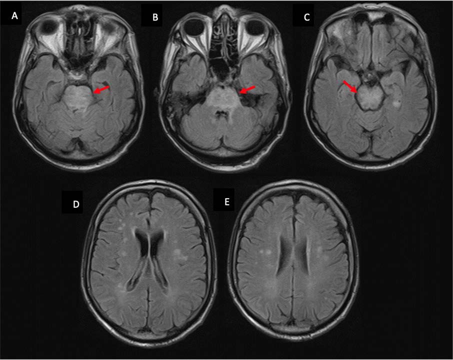 61-year-old male with SNC aspergillosis