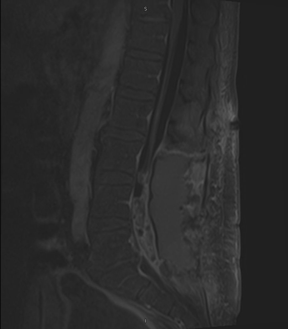 51-year-old male with progressive weakness of bilateral lower extremities.