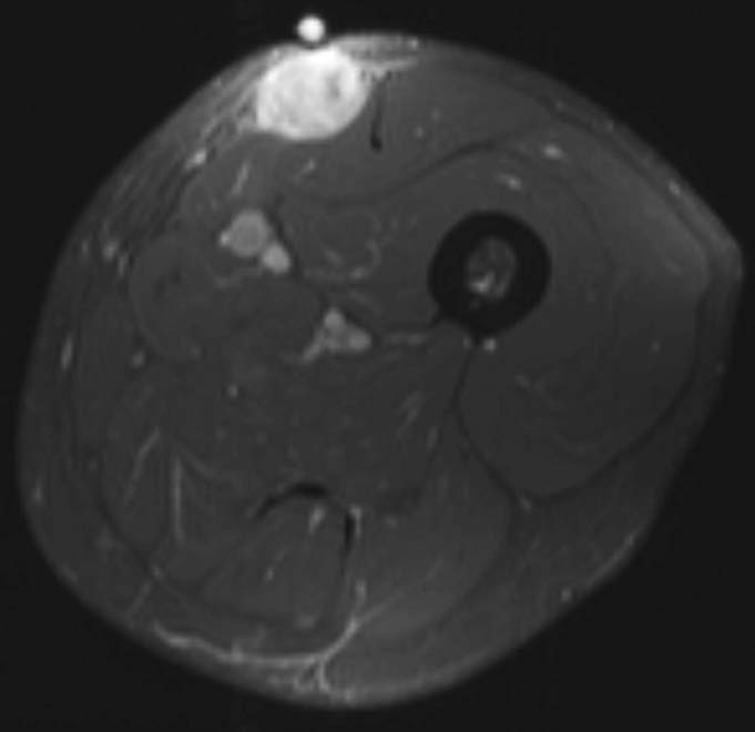 Axial T1-weighted fat-suppressed post-contrast image shows an enhancing mass in the anteromedial left thigh centered in the subcutaneous fat overlying the rectus femoris and sartorius muscles. Note the fiducial marker overlying the mass.