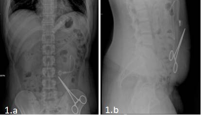 Plain X-ray of the abdomen in orthostatic PA (1.a) and LL (1.b) view demonstrates a metallic foreign body in left flanck/left iliac fossa