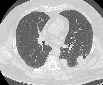 Axial CT image lung window show multiple left lower lobe lesions. The medial non-cavitating lesion was targeted for biopsy (arrow)