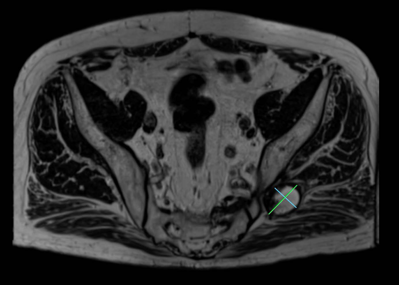 69-year-old male with mycotic pseudoaneurysm of the left SGA.