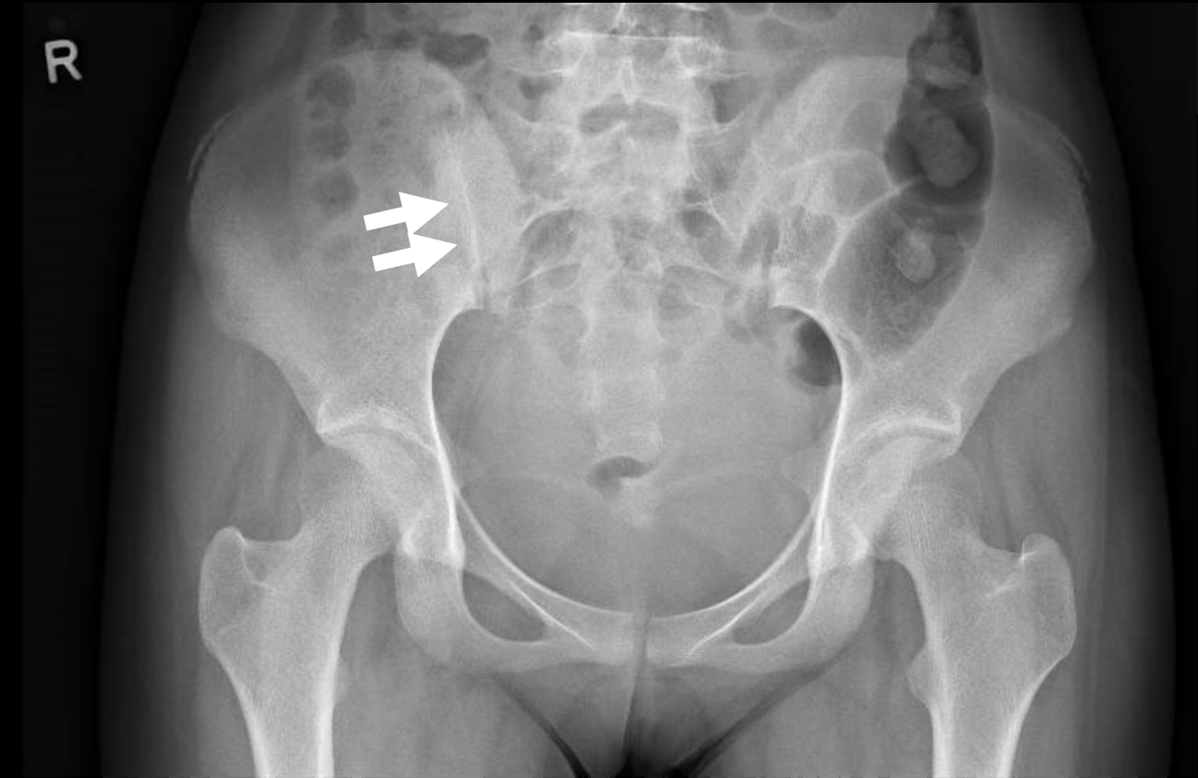 16 year old female with right pyogenic sacroiliitis.