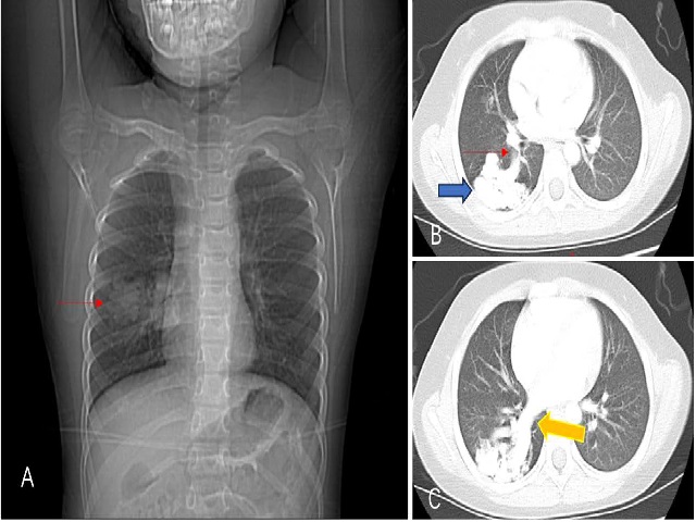 Chest Contrast-enhanced CT: A. substantial increase in mass was observed in the dorsal region of the lower lobe of the right lung