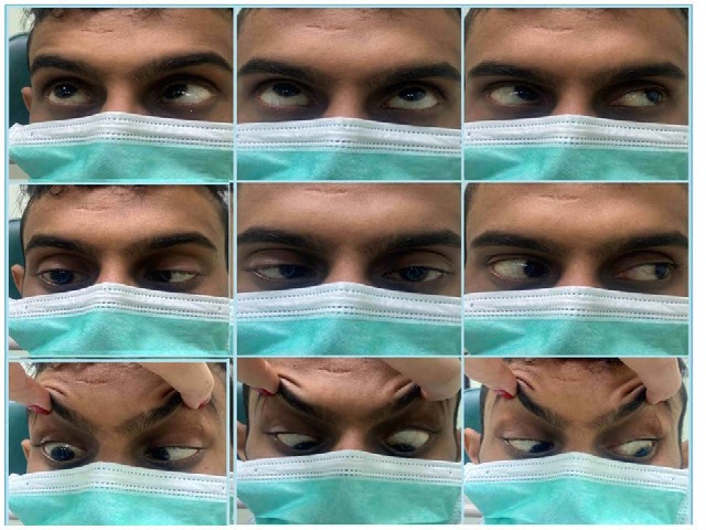 Eye movements in nine cardinal positions of gaze demonstrating a right esotropia in the primary position and a limitation of abduction in the right gaze.