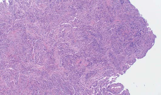 61-year-old woman with a history of follicular lymphoma and new pulmonary opacities