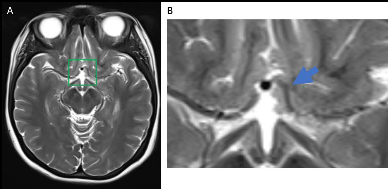 A 23-year-old female patient with infundibular dilatation of the A1 Segment of the Anterior Cerebral Artery Findings