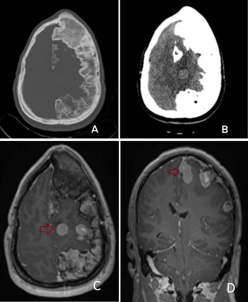 Female, 36 years-old, Basal Head CT showing known diffuse left convexity hyperostosis