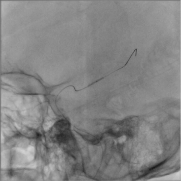 LMCA 1.5x15mm ballon angioplasty.