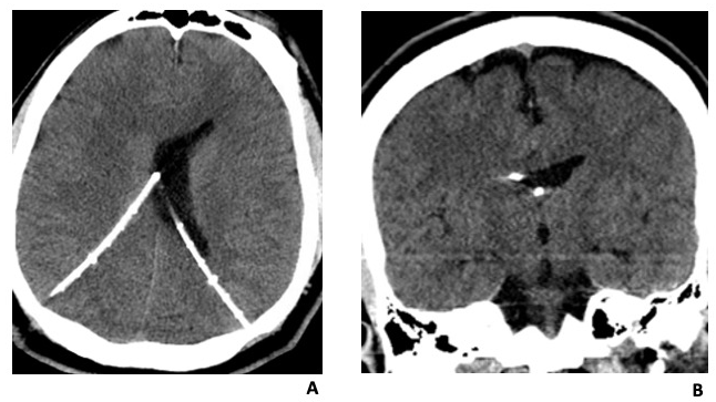 Non-contrast Head CT on admission axial