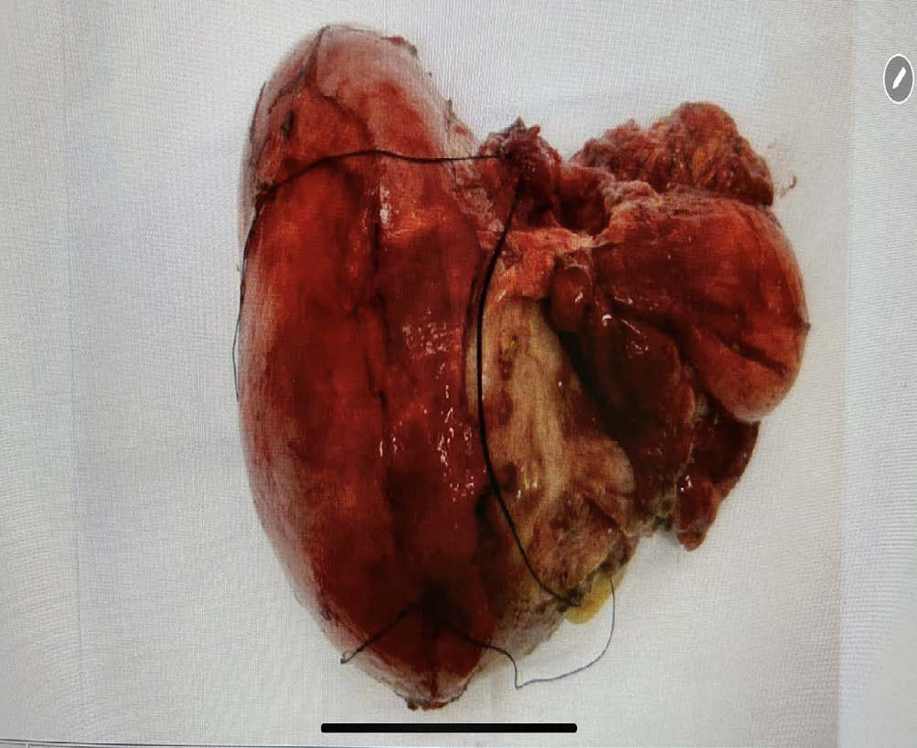 Intraoperative image from the left radical nephrectomy. Multiloculated cystic mass replacing almost the entire kidney.