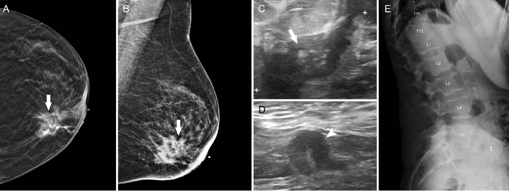 Diagnostic mammogram of the left breast with cranio-caudal