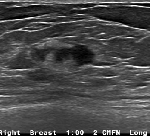 Ultrasound of the breast in long and transverse views demonstrates a 13 x 9 x 13 mm oval mass with indistinct margins with mixed echogenicity.