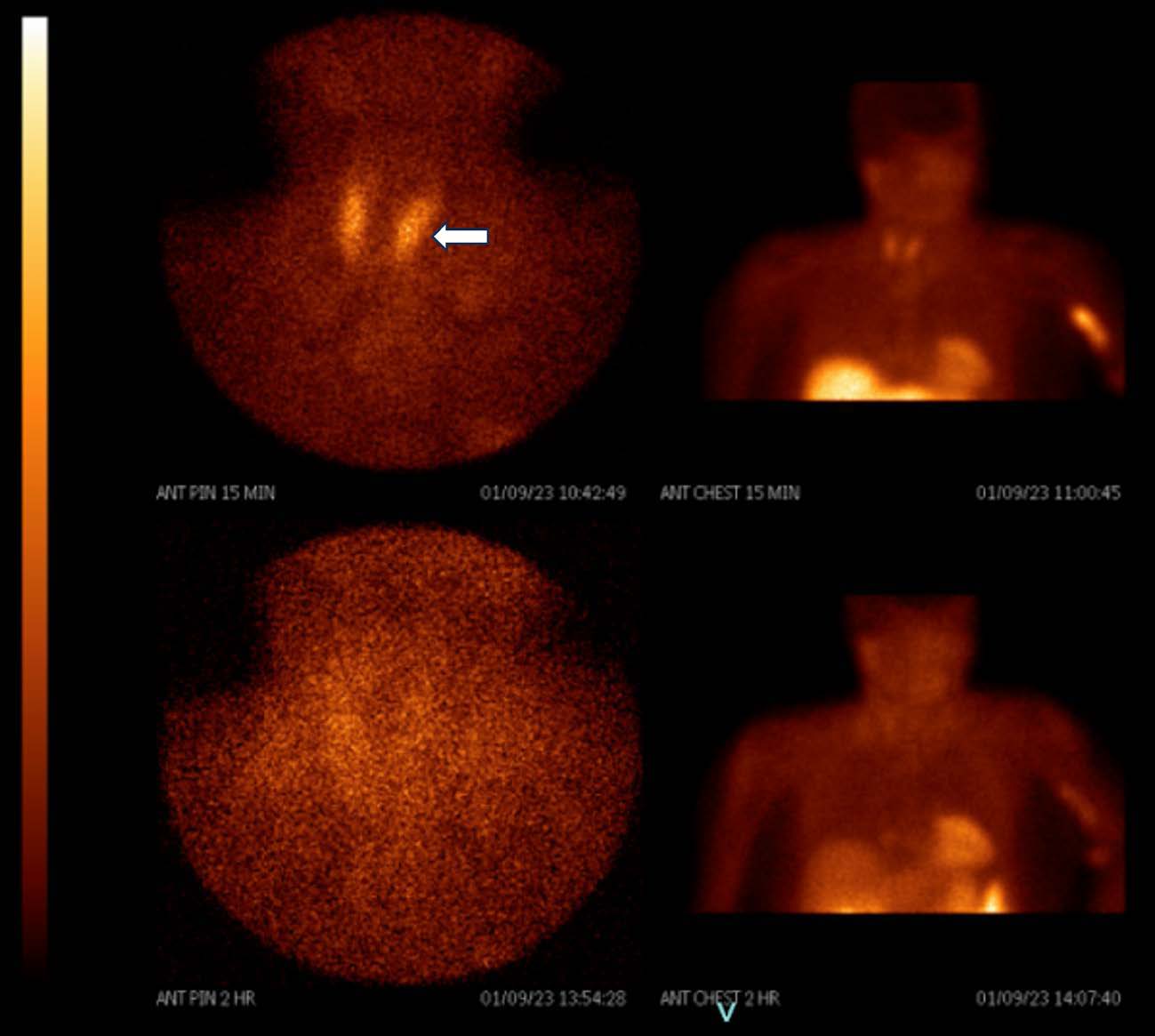 Coronal Planar SPECT, images of a 99mTc-sestamibi (MIBI) scan, demonstrate physiologic symmetric thyroid glandular radiopharmaceutical uptake and wash-out without abnormal parathyroid activity