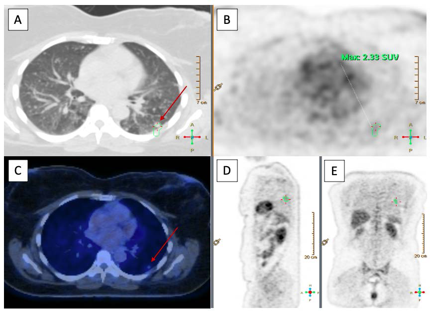 44-year-old woman with benign metastasizing leiomyoma presenting with multiple lung nodules, and neurocysticercosis.