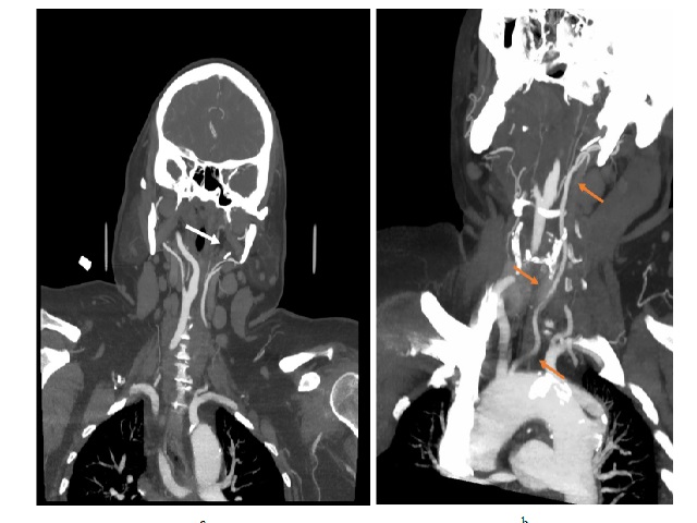 a. Coronal CT demonstrating a hypoplastic left common carotid artery terminating in branches of the left external carotid artery, and b. oblique coronal MIP image confirming the hypoplastic left carotid artery terminating in external carotid branches.