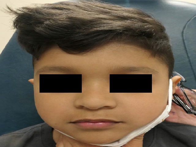 Photographs of the, a 5-year-old male, in the upright and right lateral decubitus positions show an enlarging left forehead mass when placed on his right side (arrow).