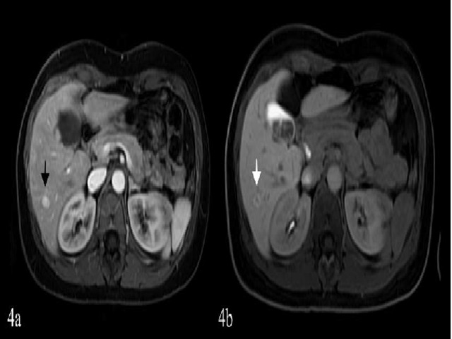 Same patient with focal nodular hyperplasia (FNH), now 38-years-old (2023).