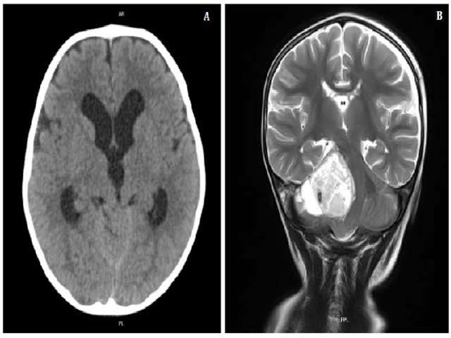 2-year-old male with medulloblastoma. FINDINGS: Axial (A) and Coronal (B) Brain MRI with tractography (A) and Nuclear MRI (B) that shows an extra-axial mass, well-defined in the cerebellopontine angle cistern, hypointense on