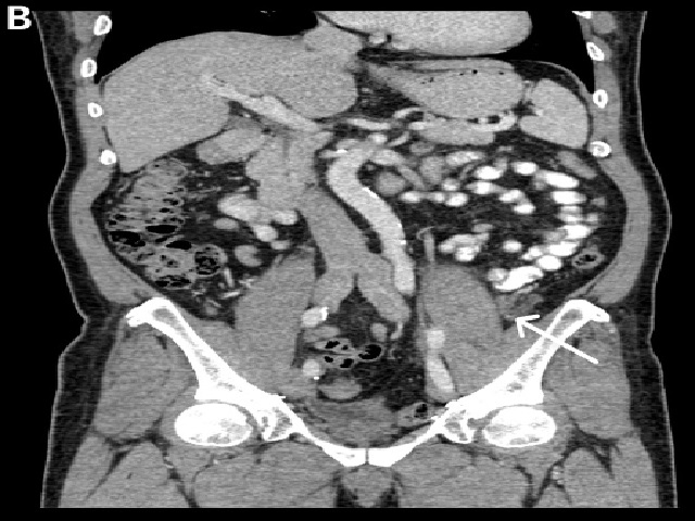 59-year-old male with urachal liposarcoma. 4th year postoperative surveillance CT.