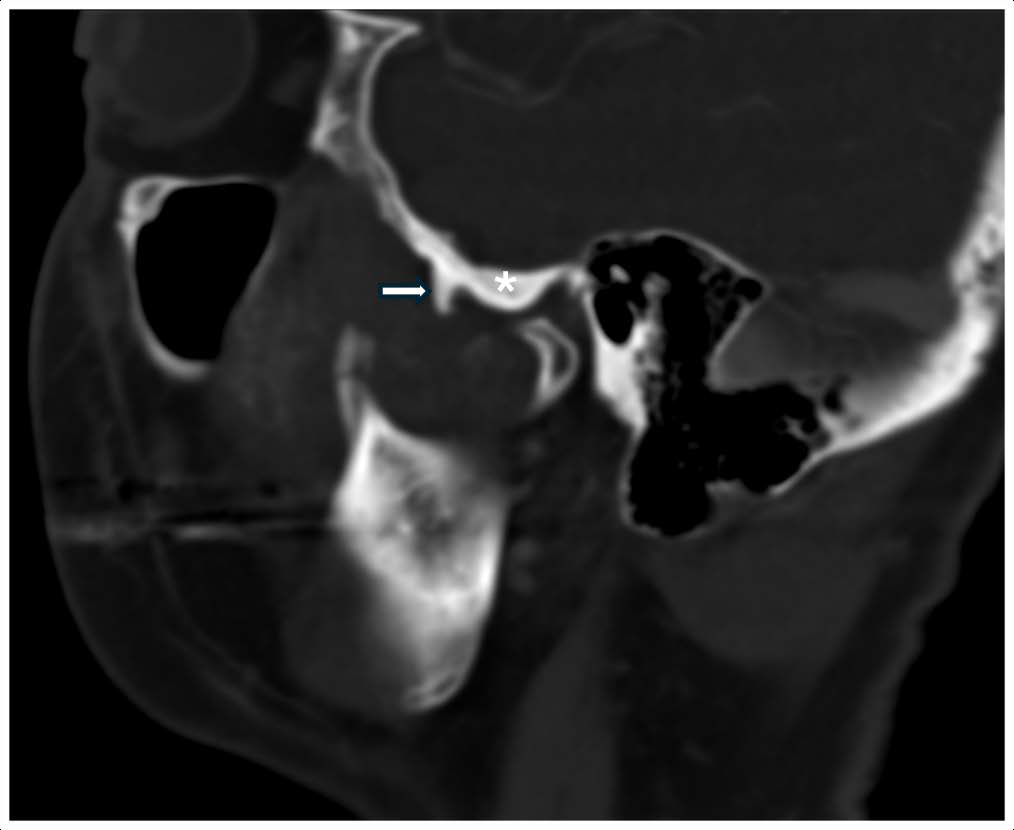 Contrast-enhanced CT (venous phase, bone window) shows a connection between the mass and the right temporal bone via a small bony stalk (arrow) anterior to the articular tubercle of the right temporomandibular joint (*).