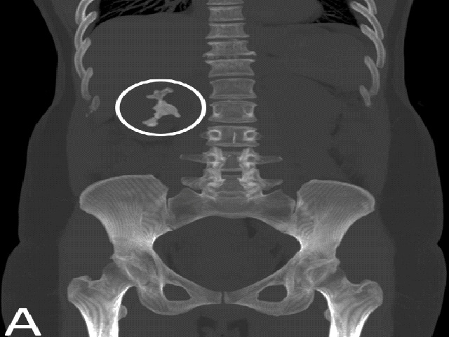 Coronal non-contrast CT MIP in bone window demonstrates original staghorn calculus (encircled in white) within the right renal collecting system.