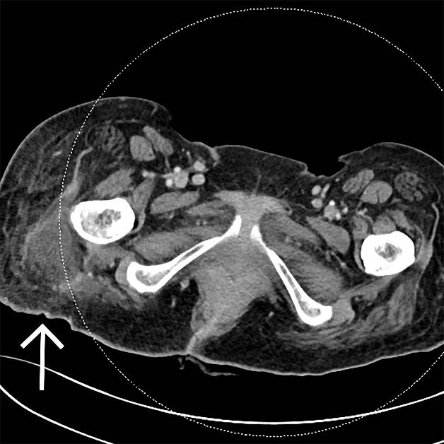 CT of the abdomen and pelvis of our 58-year-old female patient on admission, which shows partially imaged inflammatory changes of the right thigh (white arrow).