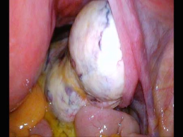 79 year old female with uterine fibroma. FINDINGS: intraoperative insight of the solid mass detected in CT. TECHNIQUE: surgery