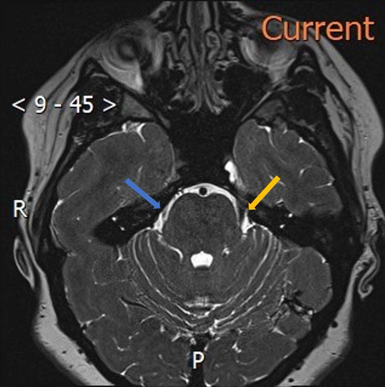 FINDINGS: Axial 3D SPACE sequence through pons demonstrates non visualization the right Meckel’s Cave (blue arrow) and a normal left Meckel’s cave (yellow arrow).