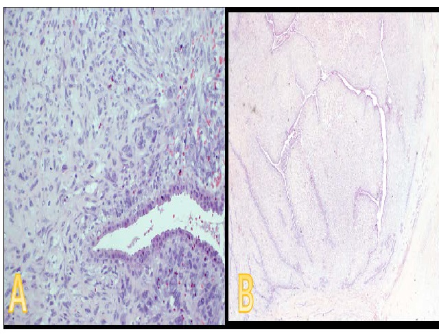 Histopathology Hematoxylin and Eosin (H&E) staining showed: stromal hypercellularity with mild cytological atypia and increase in mitotic figures (A), whereas the right side image is showing circumscribed lesion composed of stoma and benign glandular elements with intracanalicular pattern.