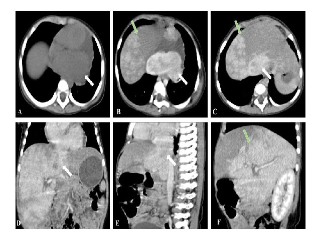 Contrast enhanced CT through level of IMT (1A: Axial section of Plain phase;