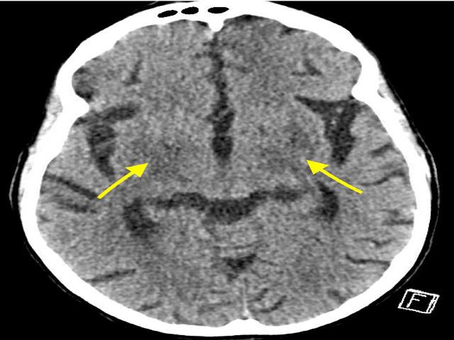 41-year old woman with CNS cryptococcosis