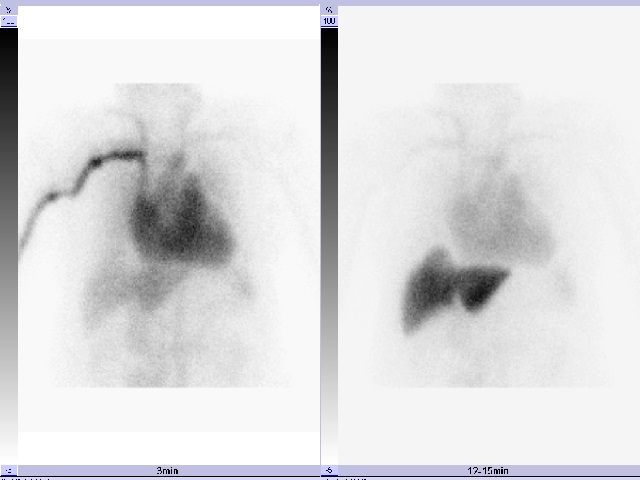 This figure illustrates images obtained at 3 minutes (left) and 12-15 minutes (right) after the injection of Technetium-99m Galactosyl Human Serum Albumin (99mTc-GSA)