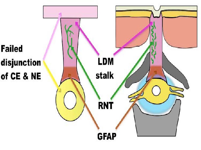 Schematic drawing of the spinal cord (yellow) and its surrounding structures during abnormal primary neurulation