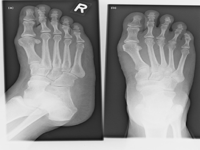 Normal navicular bone on radiographs