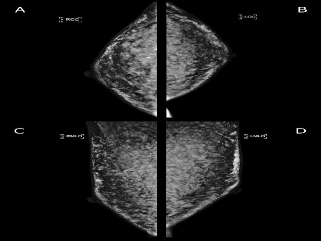 Technique – Conventional mammogram (100kVp, 30mAs), Mediolateral oblique (A–B) and Craniocaudal