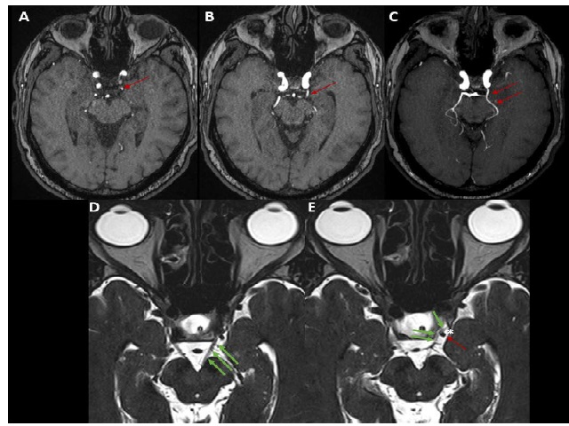 54-year-old male presenting with oculomotor neurovascular conflict. Brain MRA on axial 3D-TOF sequence (A-C)