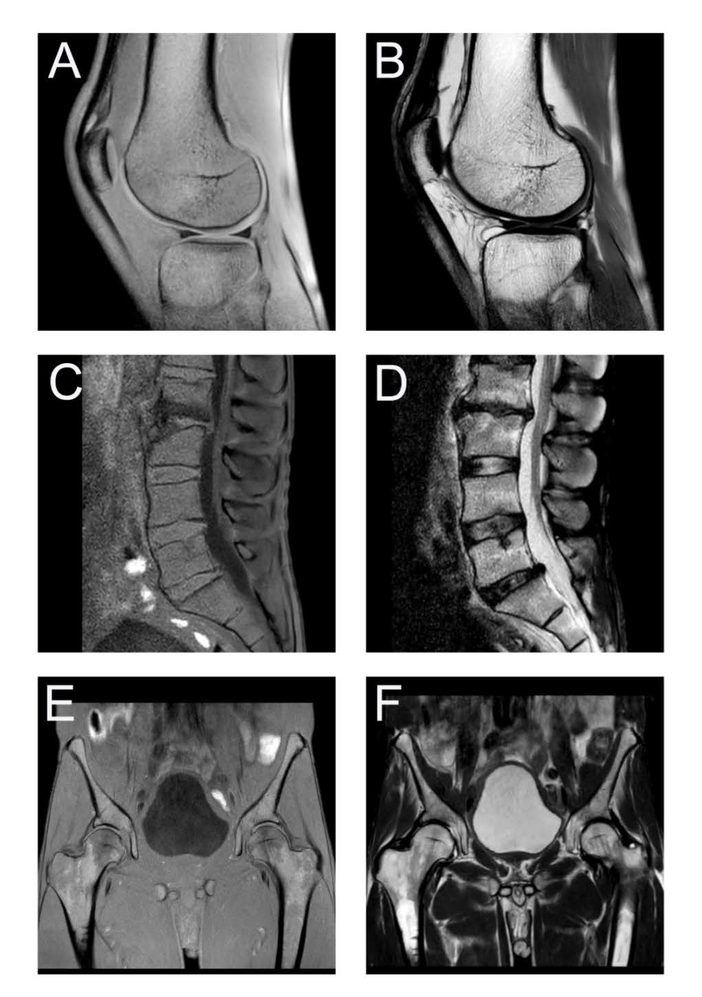 A) Sagittal T1 and B) Sagittal STIR images of the right knee was performed showing inversion of signal characteristics (the subcutaneous fat and bone marrow on the T1-weighted image are diffusely low signal and STIR images are diffusely high signal). This was repeated due to presumed technical error with same result. C) Sagittal T1-weighted and STIR image D) show similar result in the lumbar spine and showing minimal subcutaneous fat. E) Coronal T1-weighted and STIR image F) showing inversion of signal and very little subcutaneous fat.