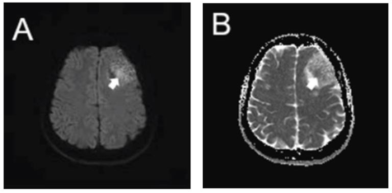 A 46-year-old female with mixed atypical, microcystic, and angiomatous meningioma.