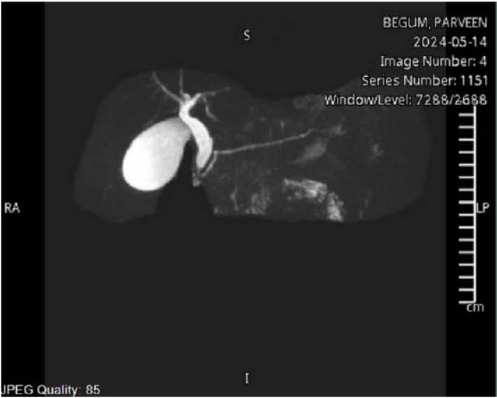 MRCP. 42 year old female diagnosed with acute pancreatitis.