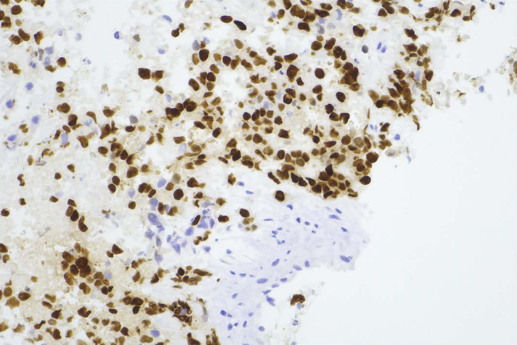 63 year old female with microscopic histopathology (20x magnification) showing non-small cell lung carcinoma